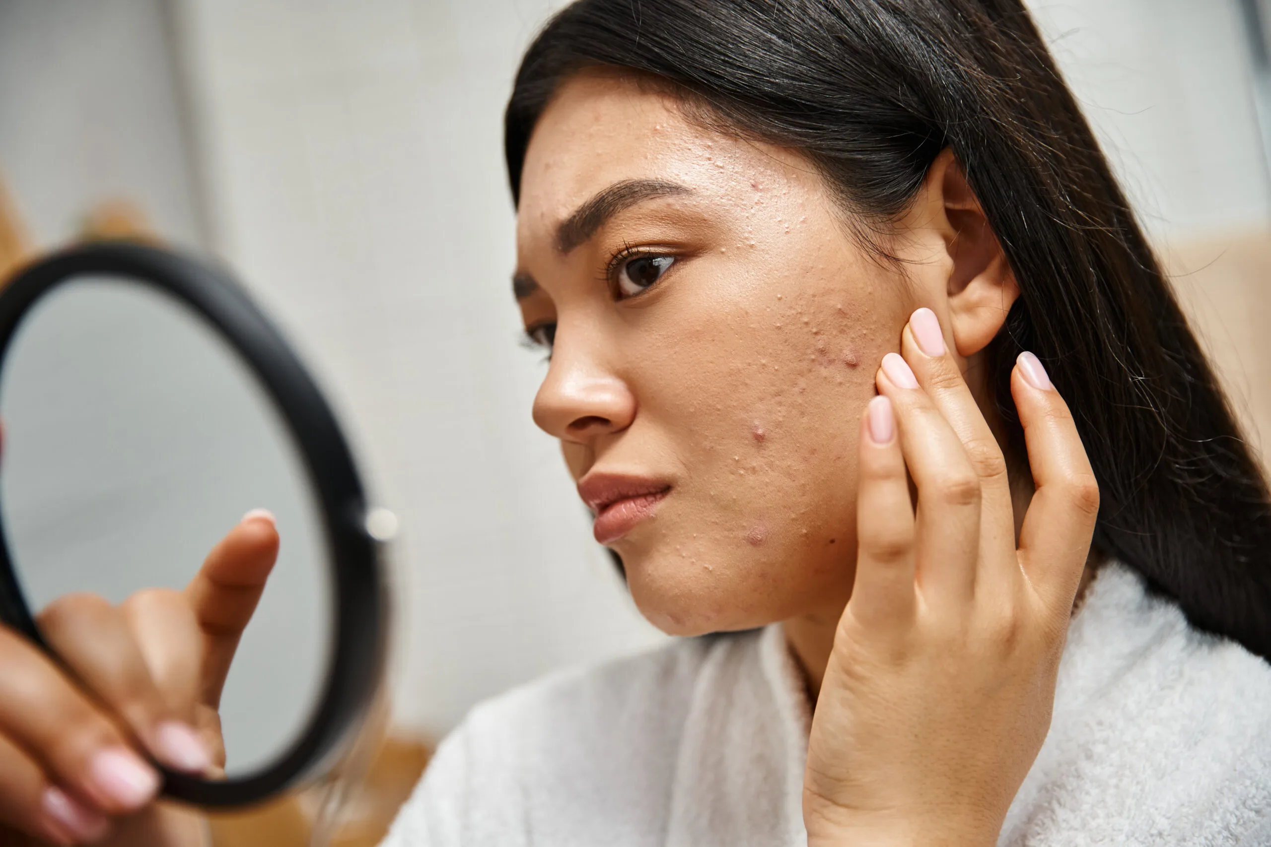 Acne and breakouts