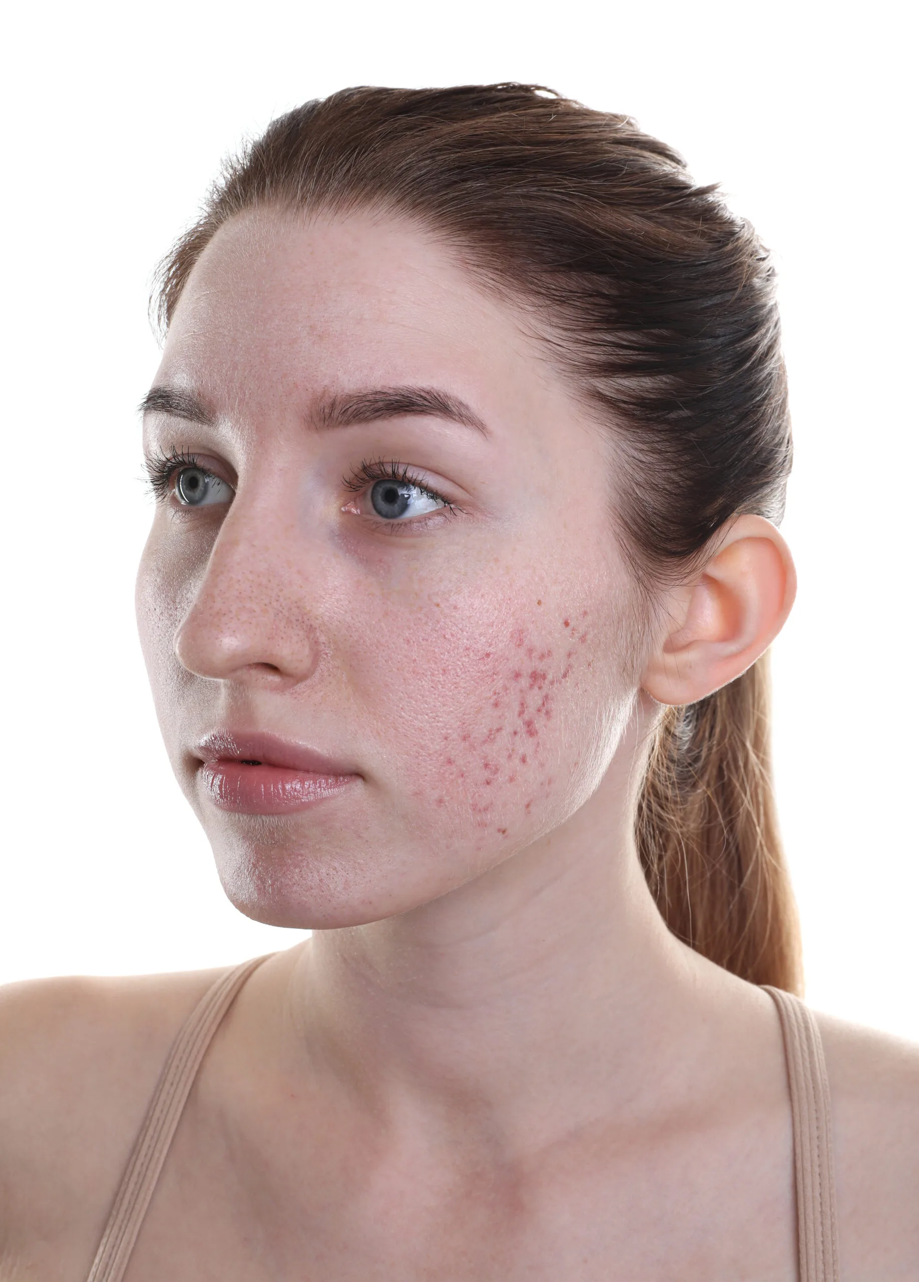 Acne scars