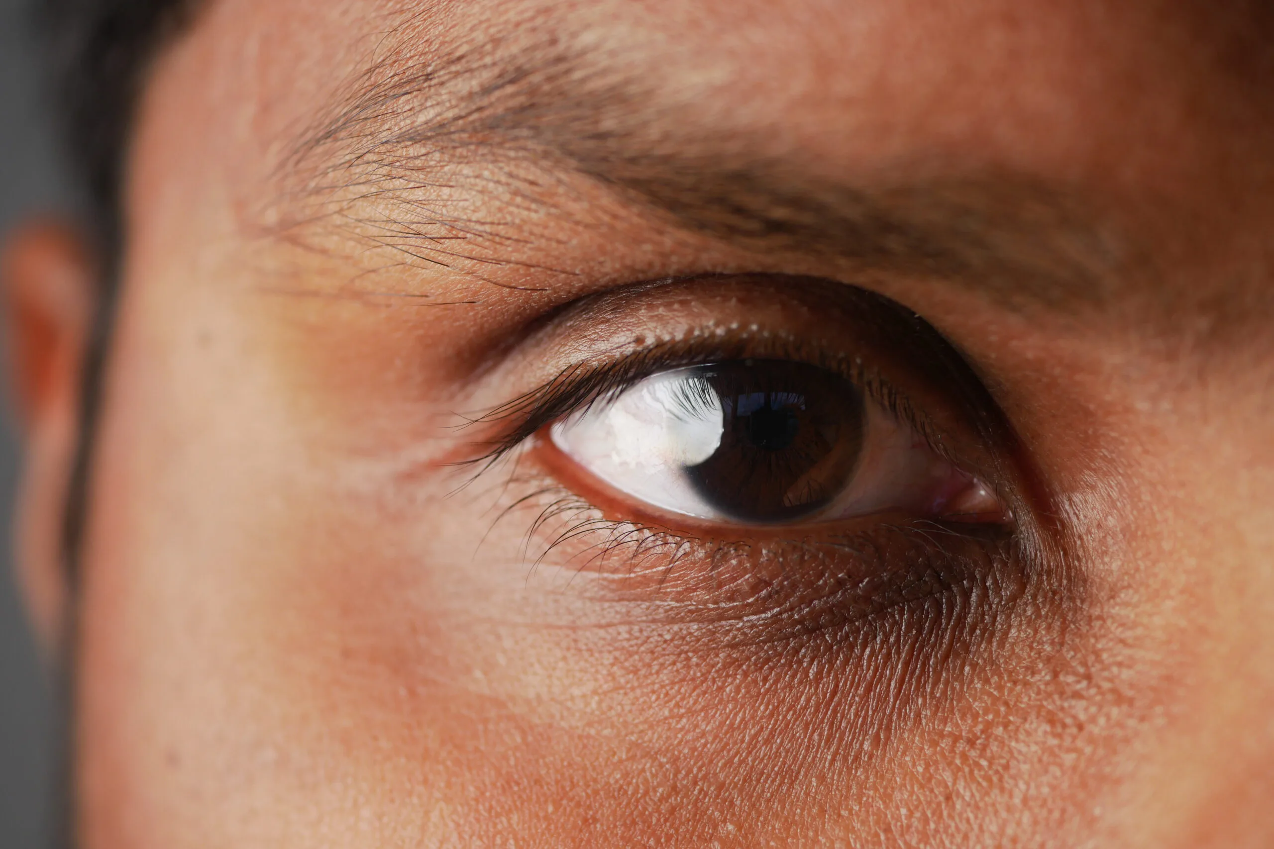 Dark circles