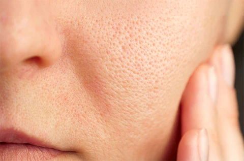 Open pores and oily skin