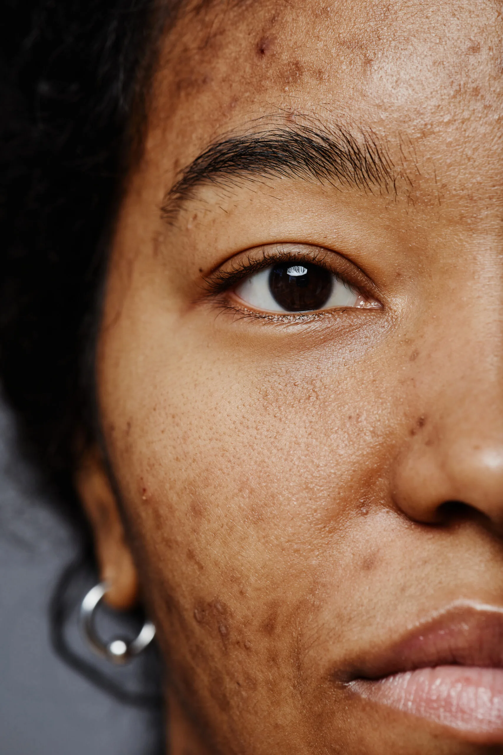 Pigmentation and melasma