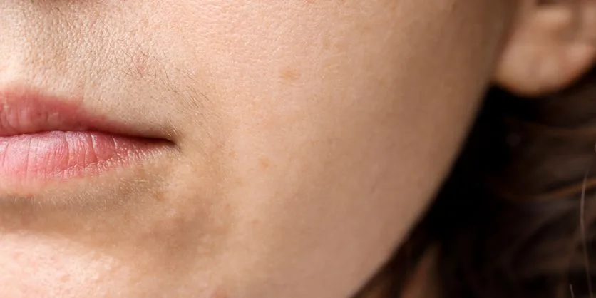 Unwanted hair removal