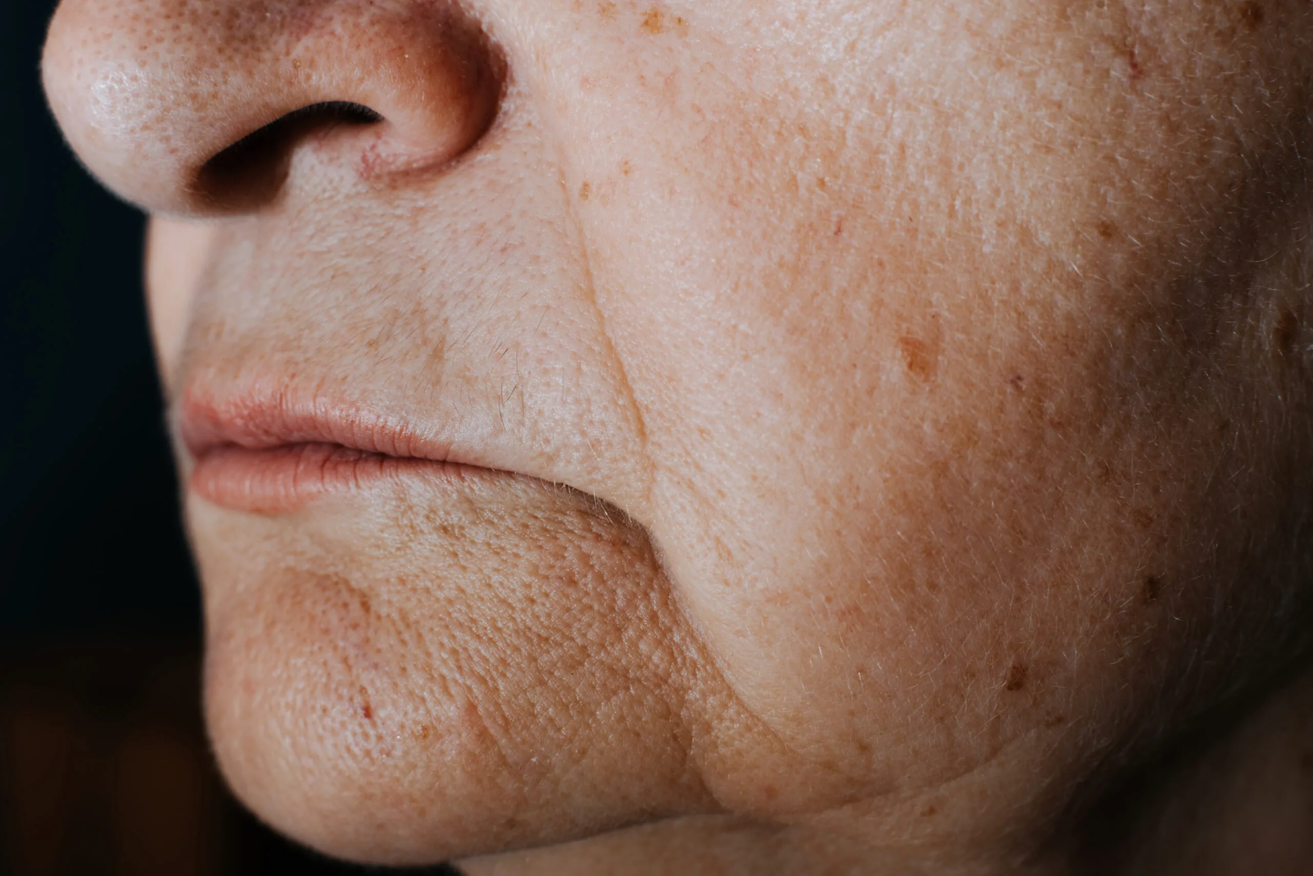 Wrinkles and ageing