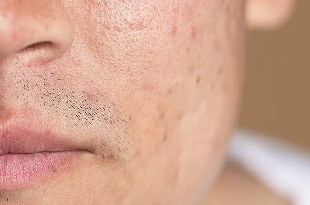 Age-related open pores treatment in Delhi