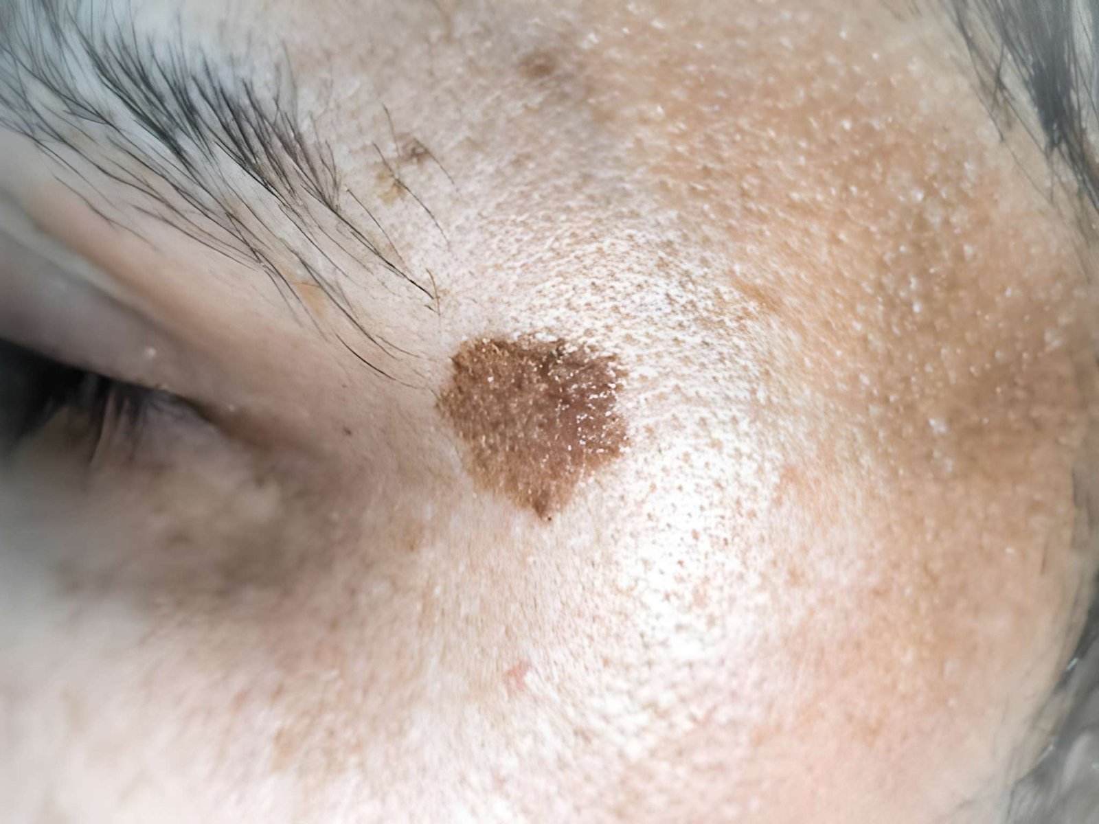 Atypical dysplastic mole assessment in Delhi