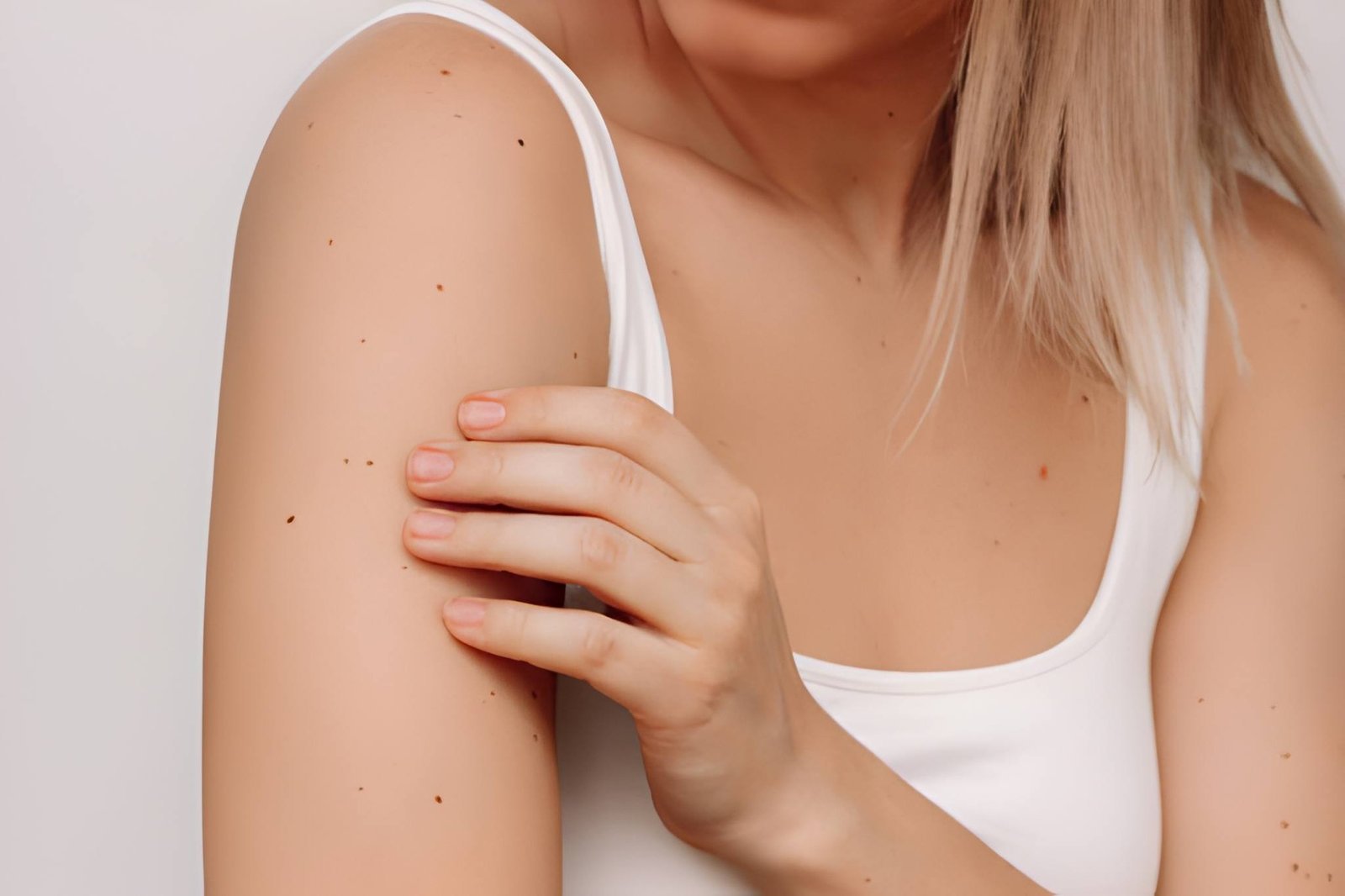 Body mole removal treatment in Delhi