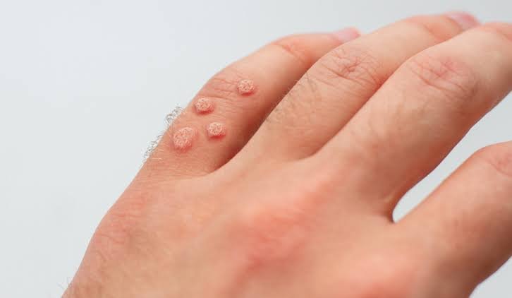 Common warts treated with wart removal treatment in Delhi