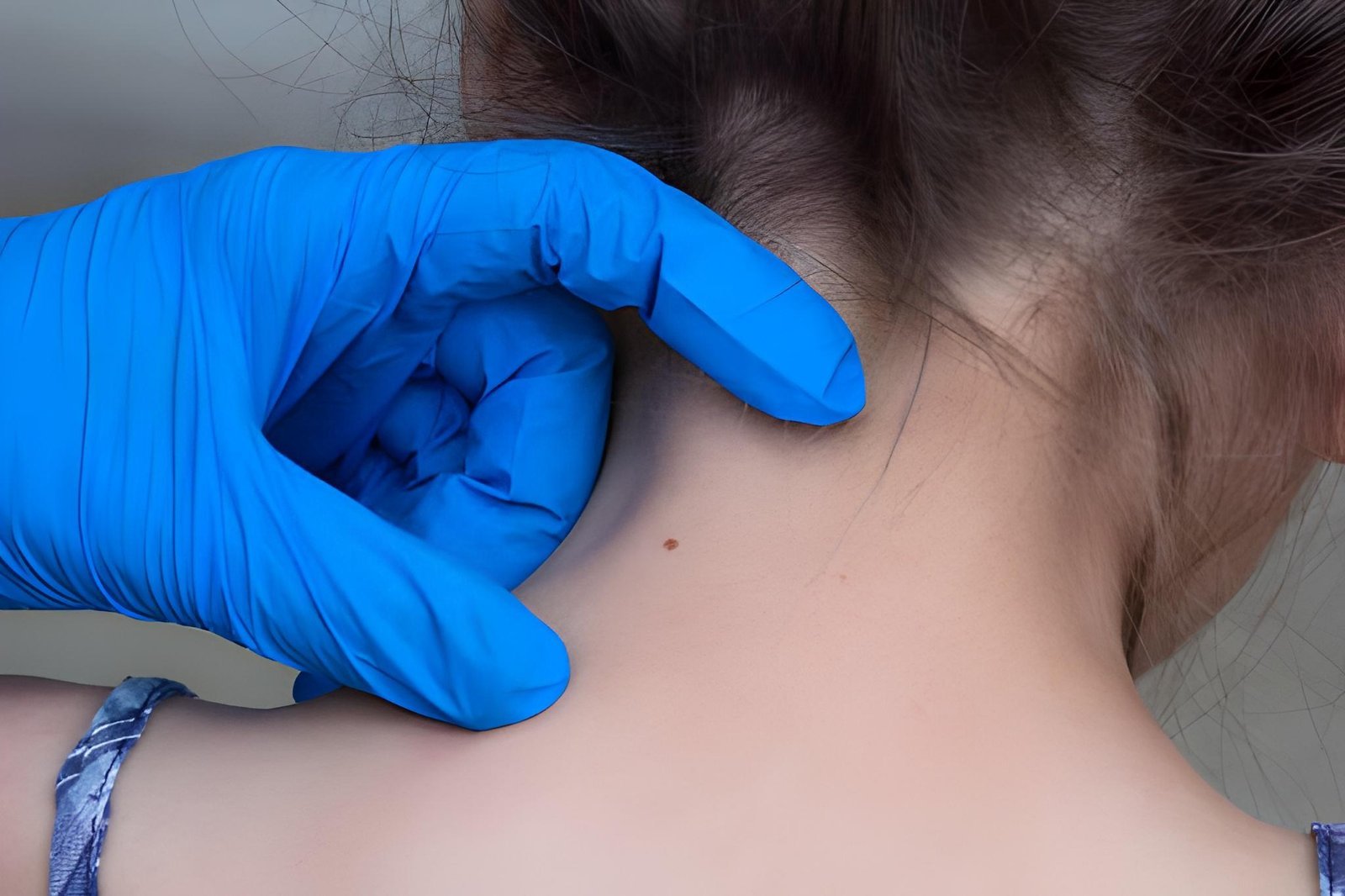 Congenital moles assessed by a dermatologist in Delhi