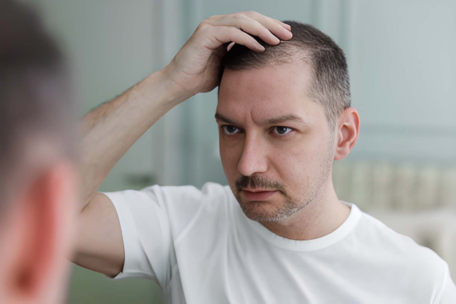 Crown and vertex hair thinning