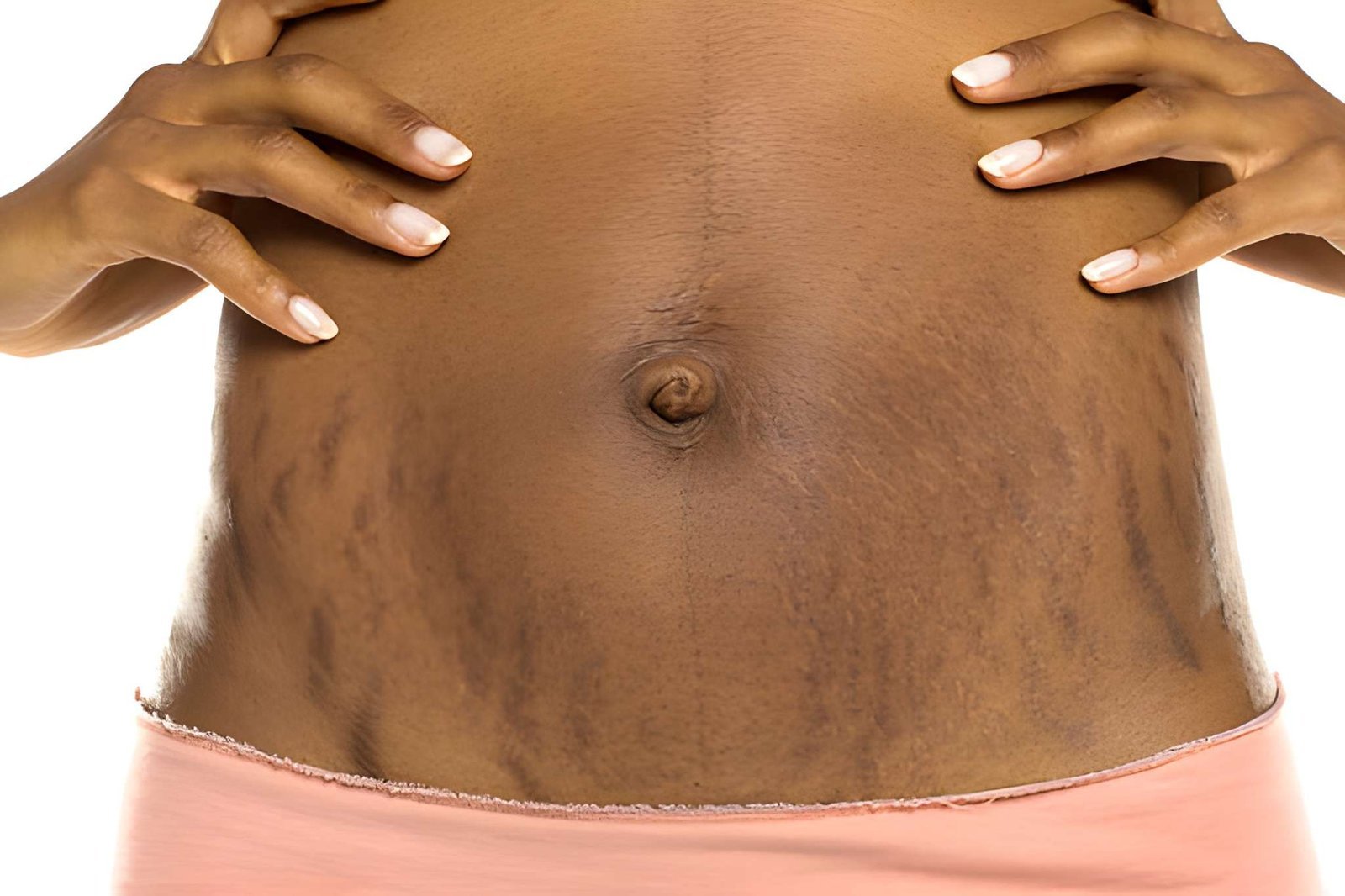 Dark stretch marks treatment in Delhi