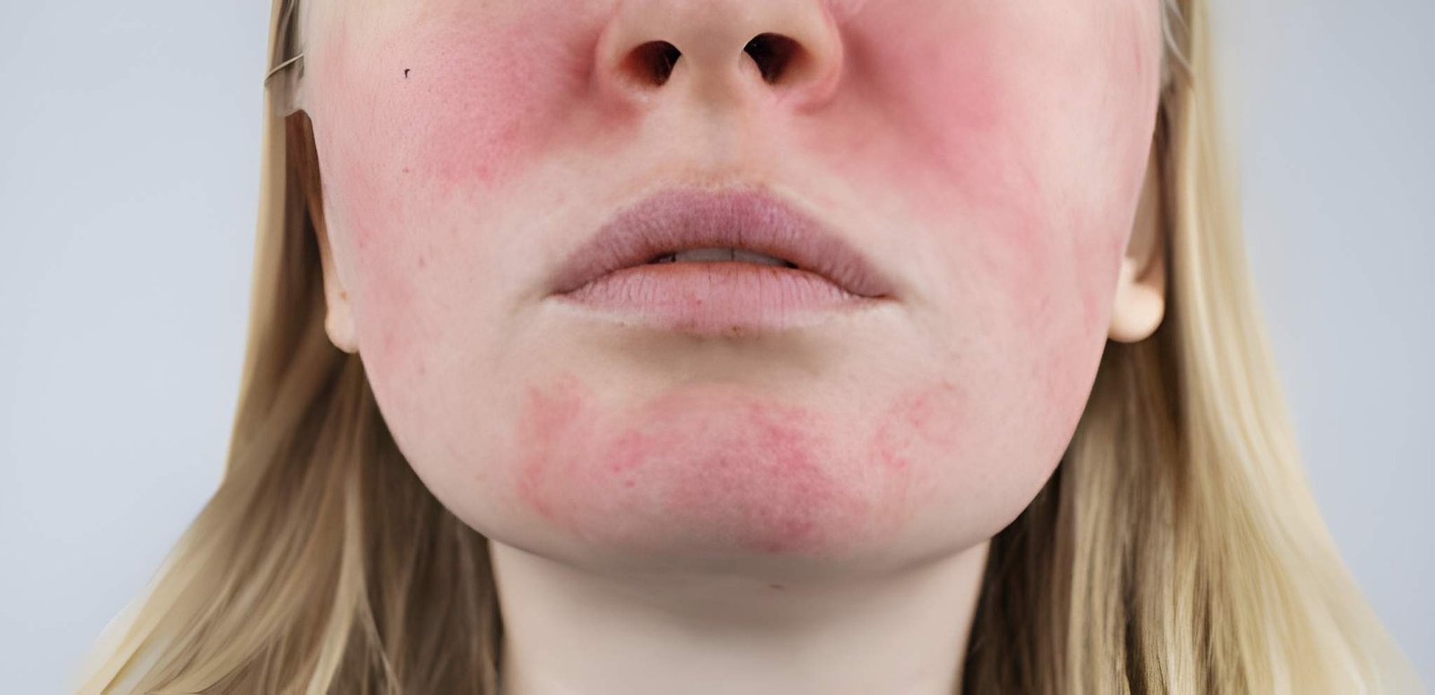 Dermatitis-related sensitive skin treatment in Delhi