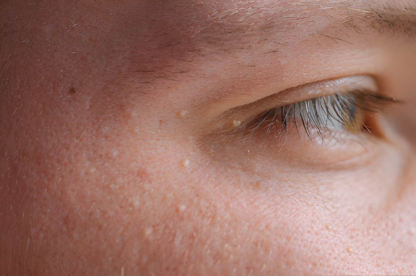 Eyelid skin tags treated by a dermatologist in Delhi