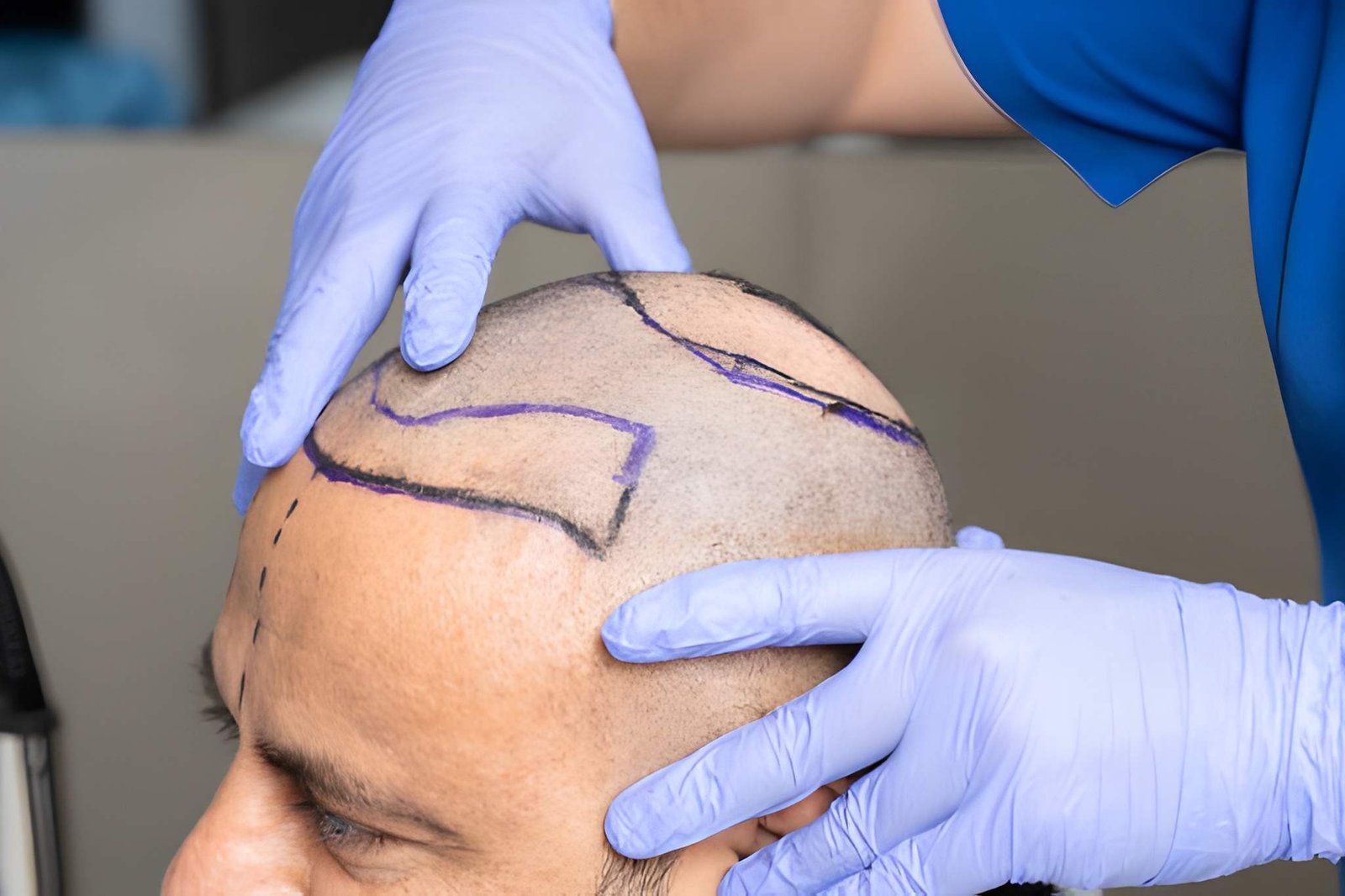 Oral and topical medication prescribed by a hair fall doctor in Delhi at Skinfollix