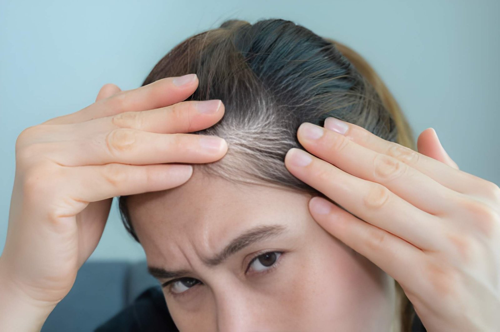 Female pattern hair loss treatment at Skinfollix, hair clinic in Delhi
