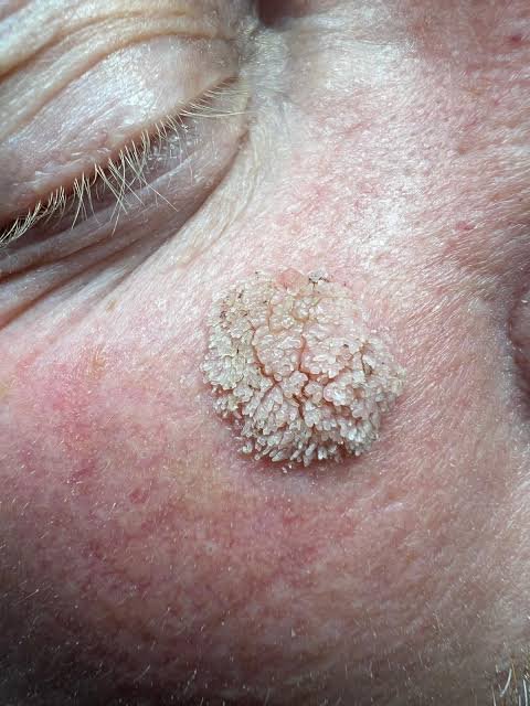 Filiform warts treated by a dermatologist in Delhi