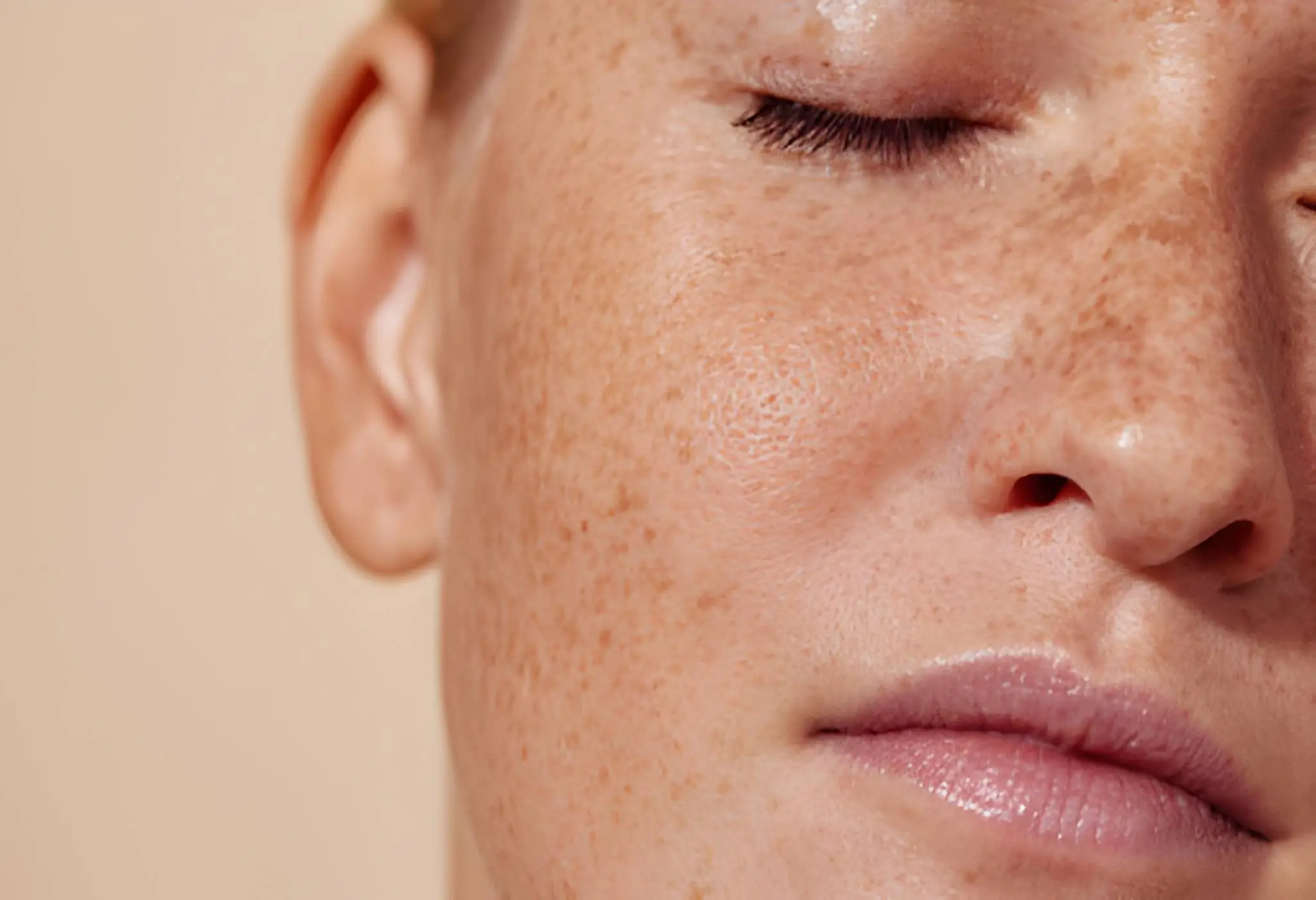 Freckles Treatment in Delhi at Skinfollix
