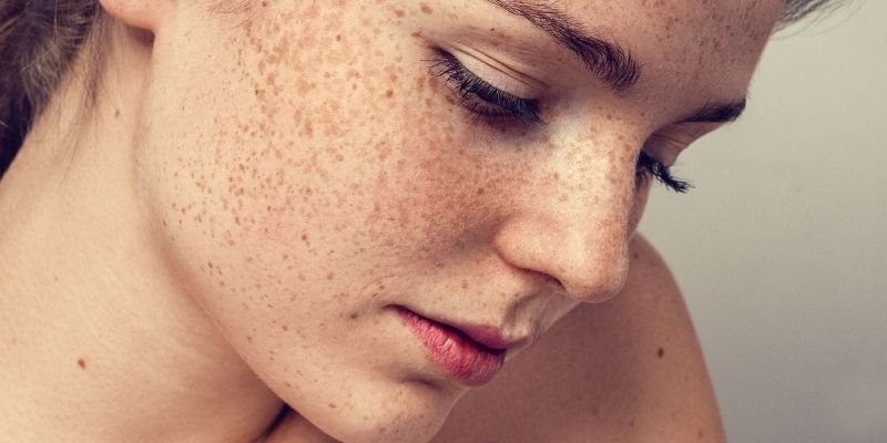 Freckles on facial skin