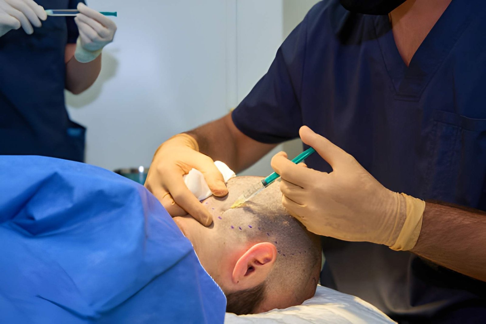 GFC therapy for early-stage male pattern hair loss at Skinfollix, hair treatment clinic in Delhi