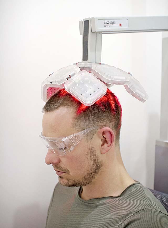 Low-level laser therapy for hair growth treatment in Delhi at Skinfollix