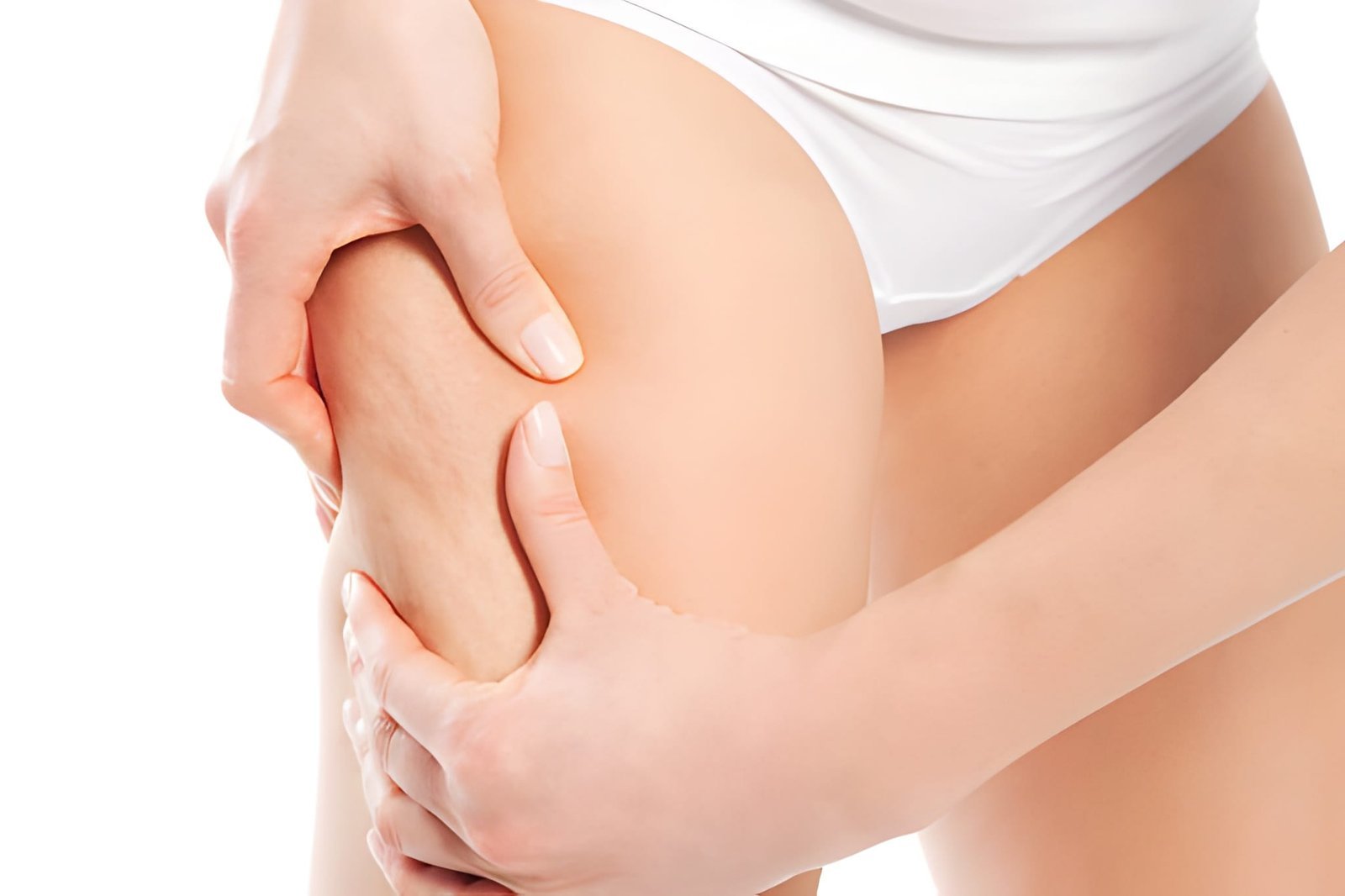 Mature stretch marks treatment in Delhi