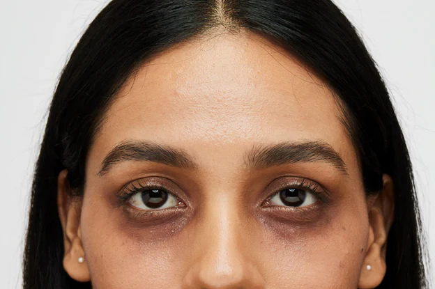 Mild dark circles treatment in Delhi