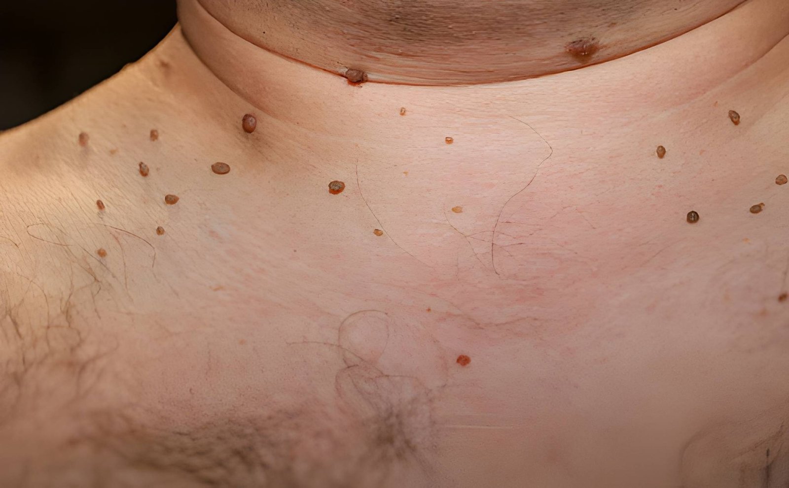 Multiple skin tags treated with skin tag removal treatment in Delhi