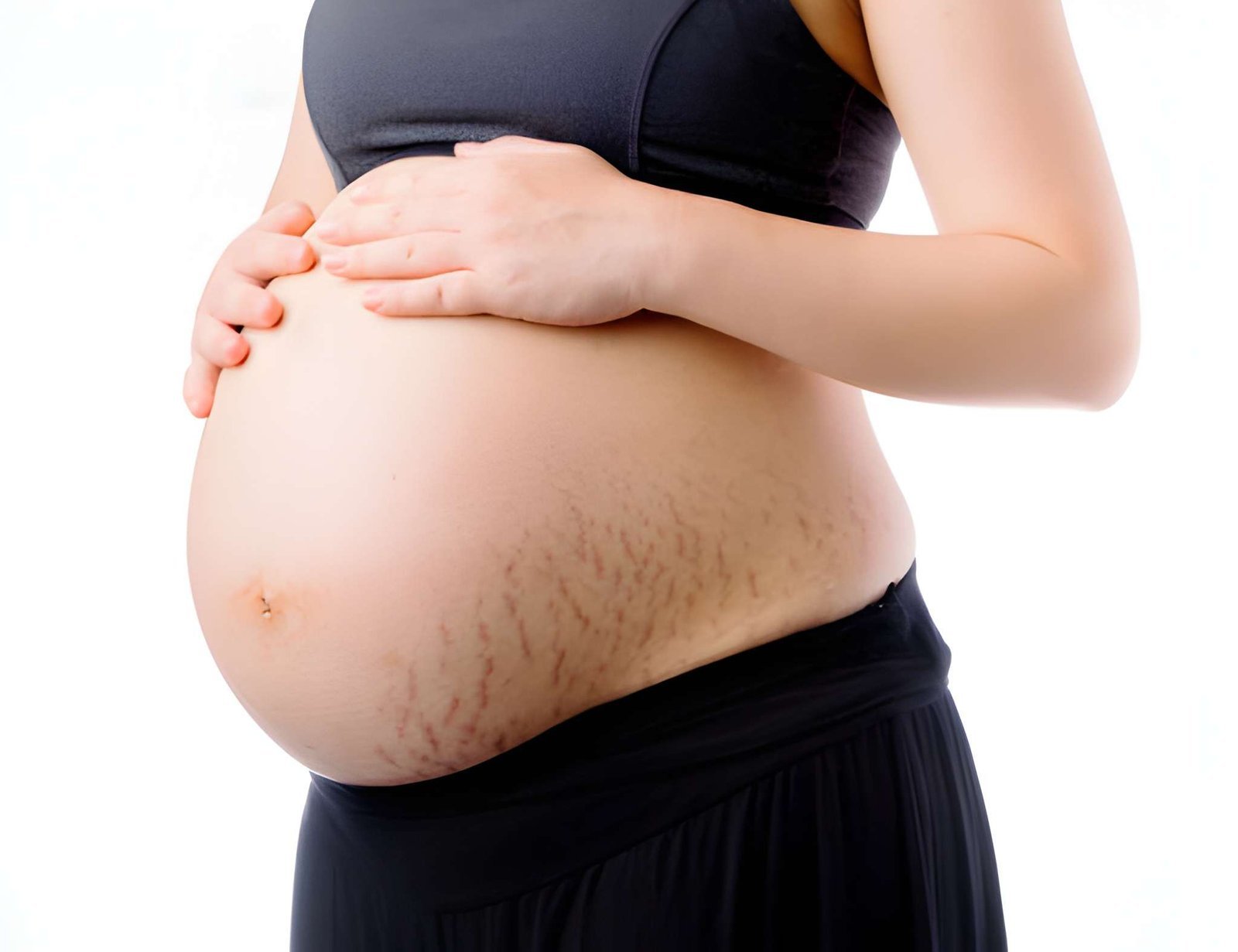 New stretch marks treatment in Delhi