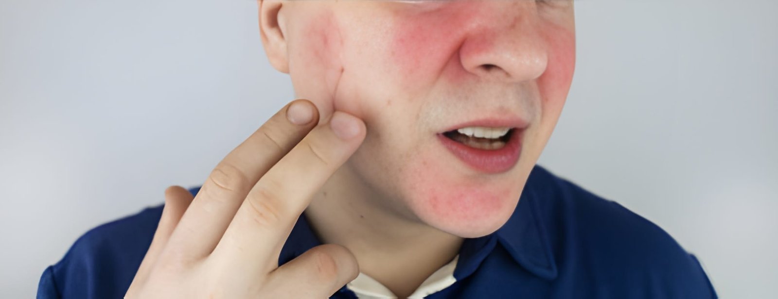 Ocular manifestations of rosacea treatment in Delhi