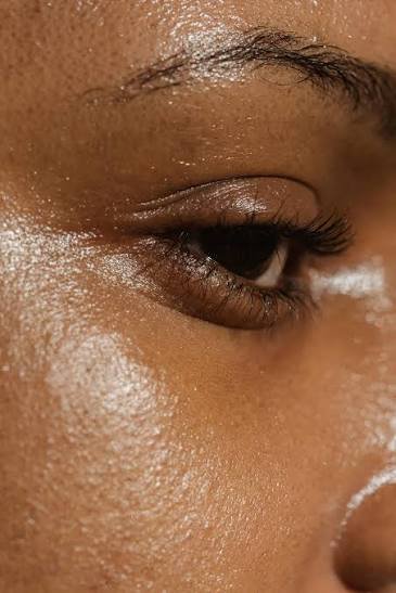 Oil-related open pores treatment in Delhi