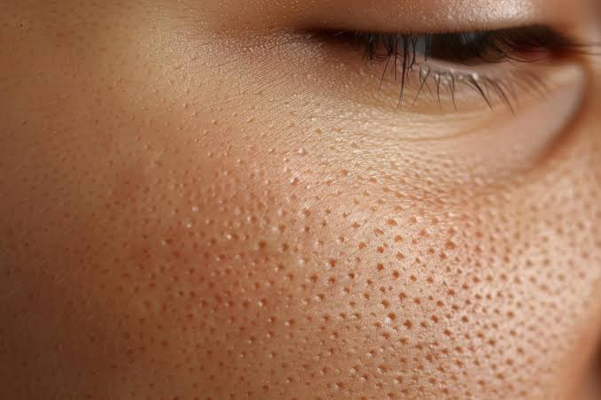 Open Pores Treatment in Delhi at Skinfollix