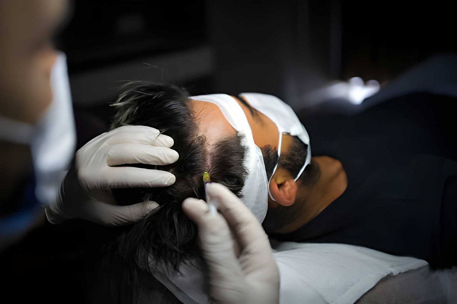 PRP therapy for male hair loss treatment in Delhi at Skinfollix
