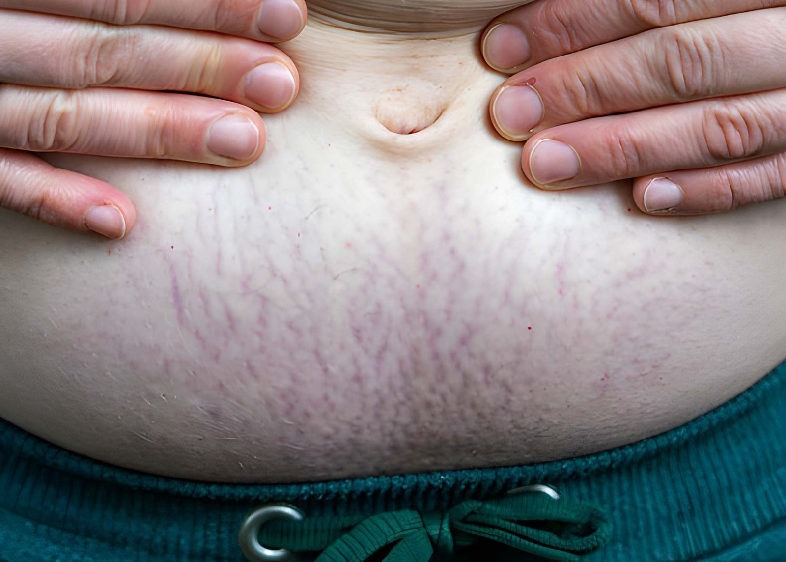 Purple stretch marks treatment in Delhi