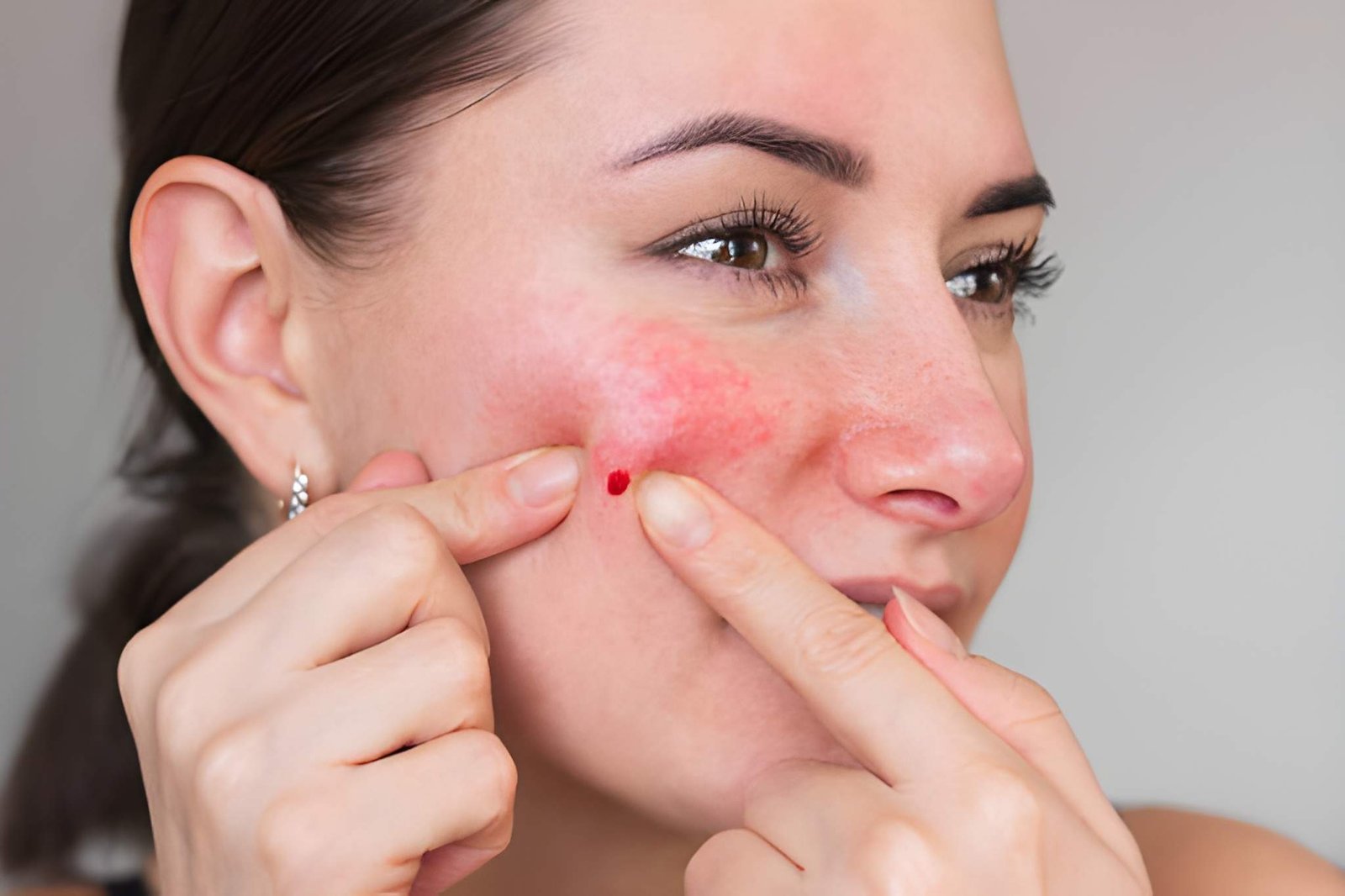 Papulopustular rosacea treatment in Delhi