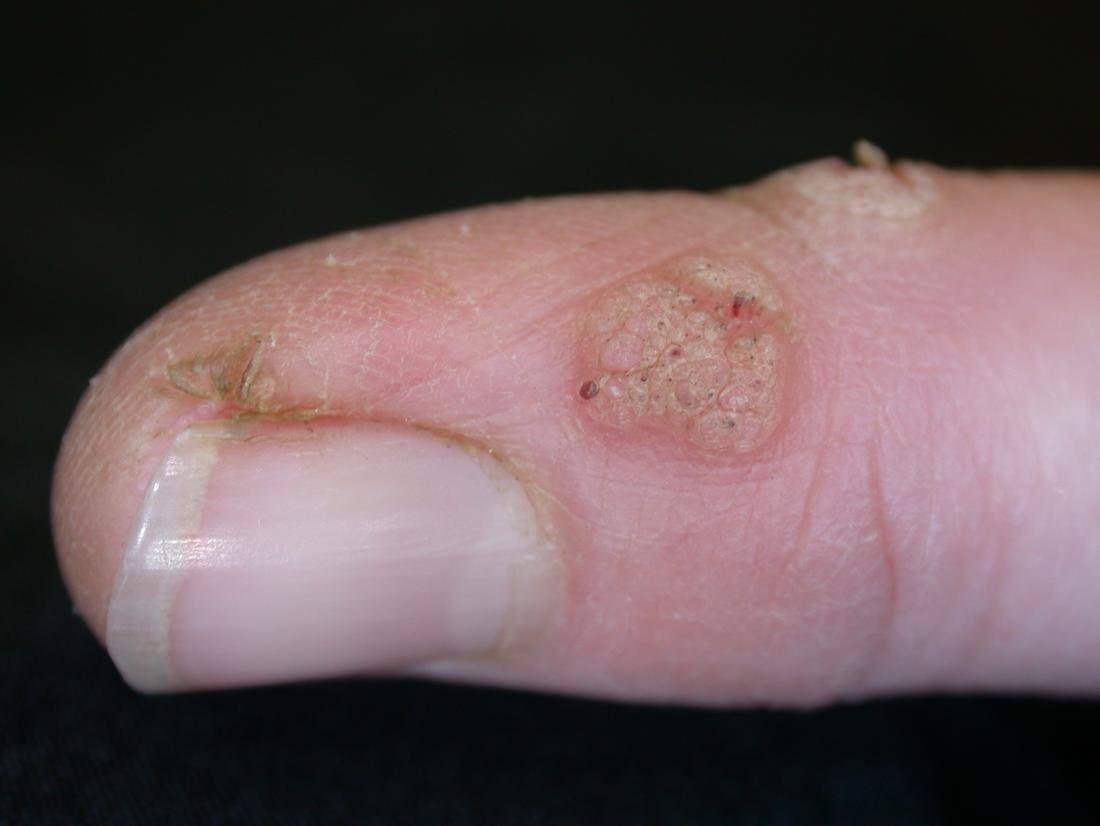 Periungual warts assessed for wart removal in Delhi