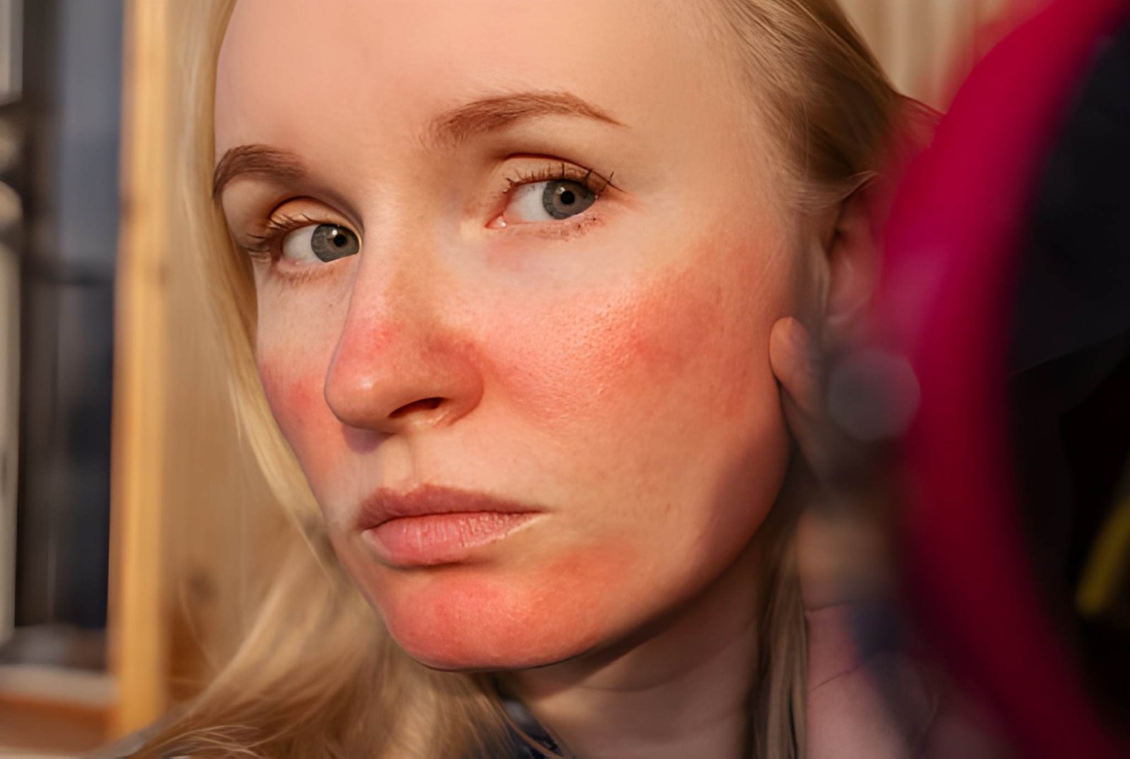 Persistent facial redness rosacea treatment in Delhi