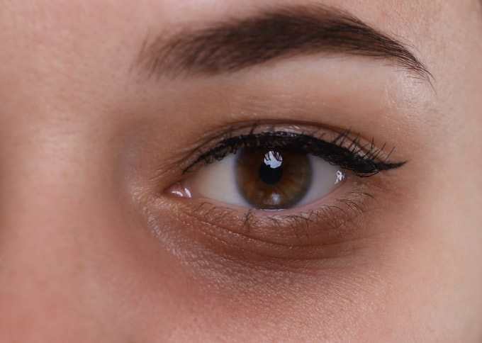 Pigmented dark circles treatment in Delhi