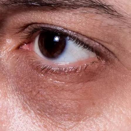 Prominent dark circles treatment in Delhi