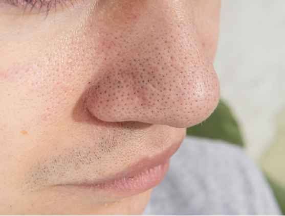 Prominent open pores treatment in Delhi
