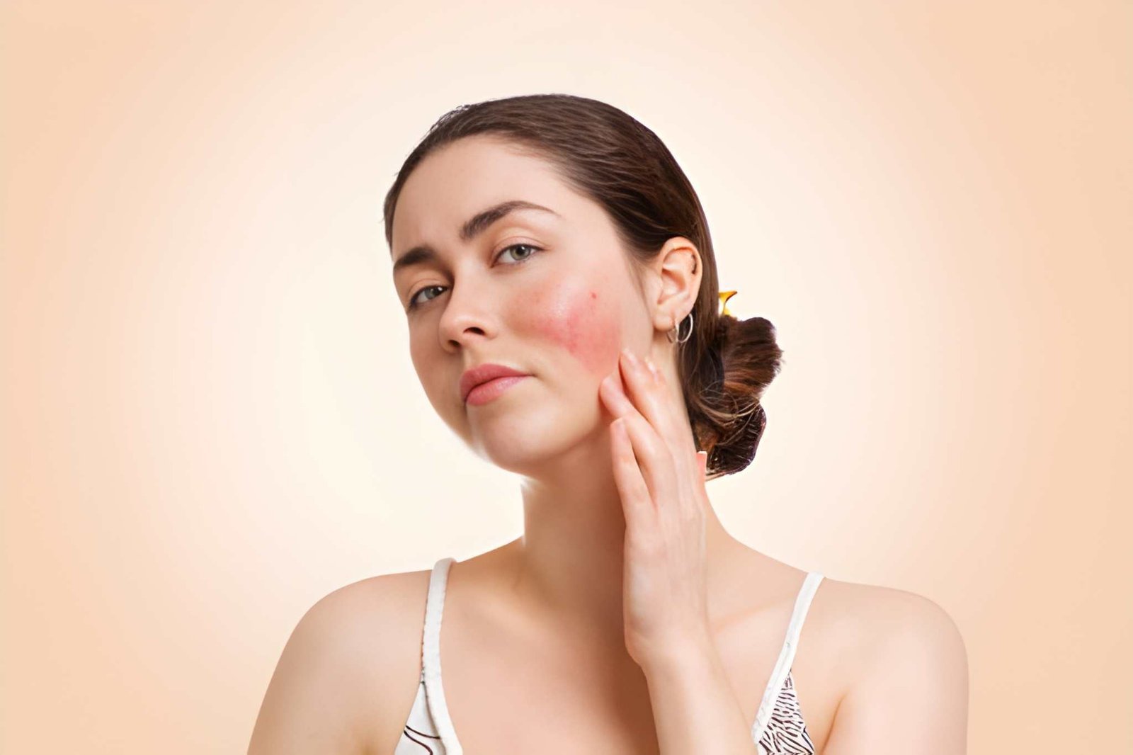 rosacea treatment in Delhi at Skinfollix Clinic