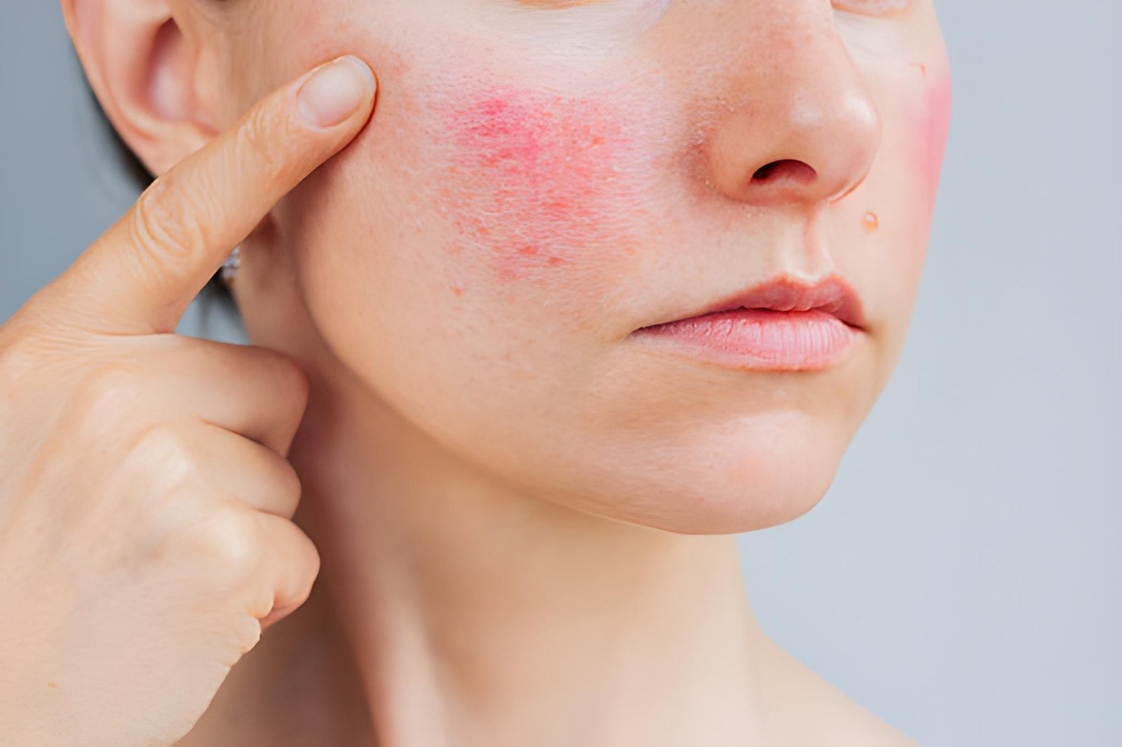 Rosacea-associated sensitive skin treatment in Delhi