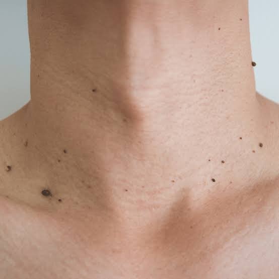 Groin and skin fold tags assessed for skin tag removal treatment in Delhi
