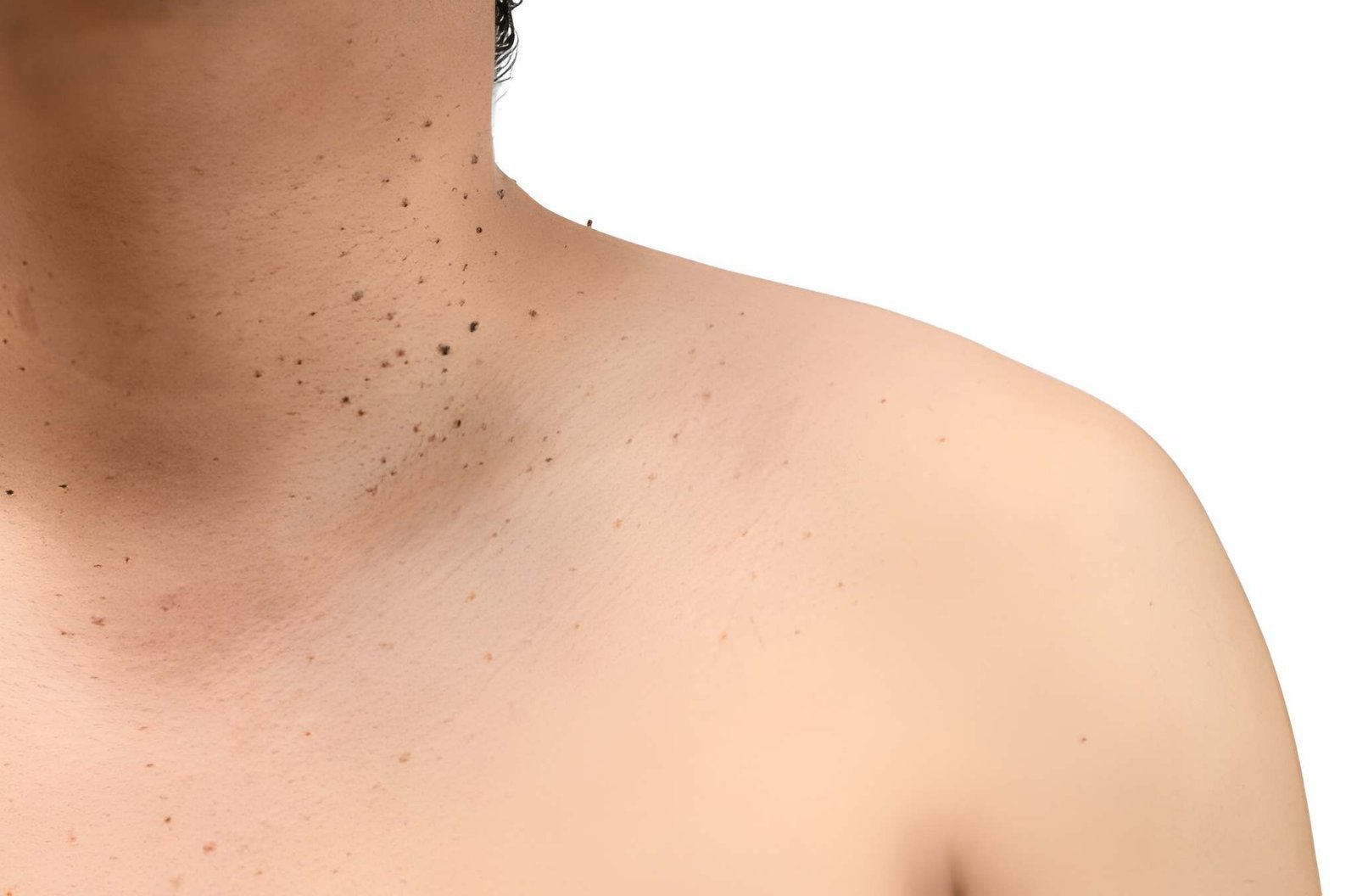 Skin tag removal treatment in Delhi at Skinfollix Clinic