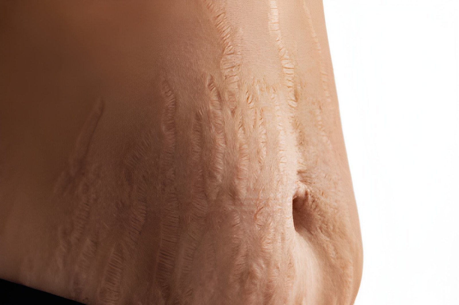 Slightly raised stretch marks treatment in Delhi