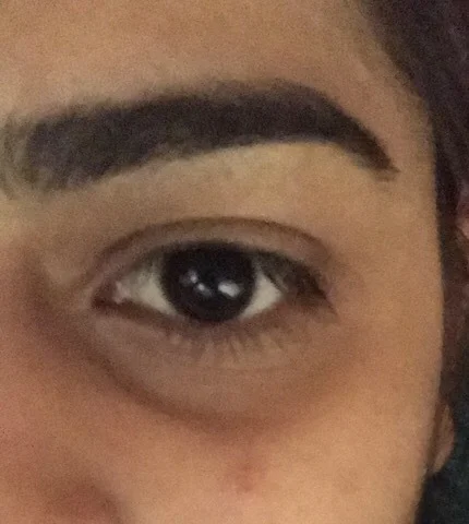 Structural hollow dark circles treatment in Delhi