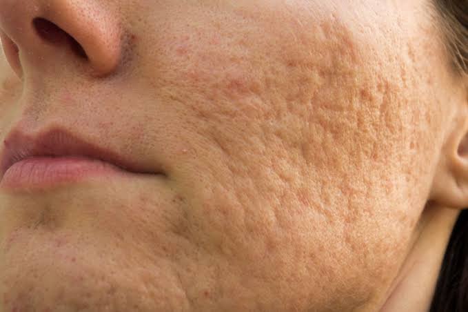 Sun-induced open pores treatment in Delhi