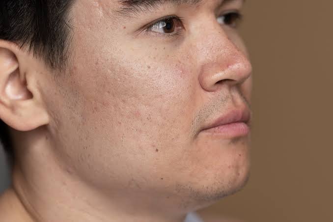 Symptoms of open pores on the skin