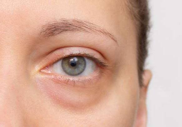 Symptoms of under eye dark circles