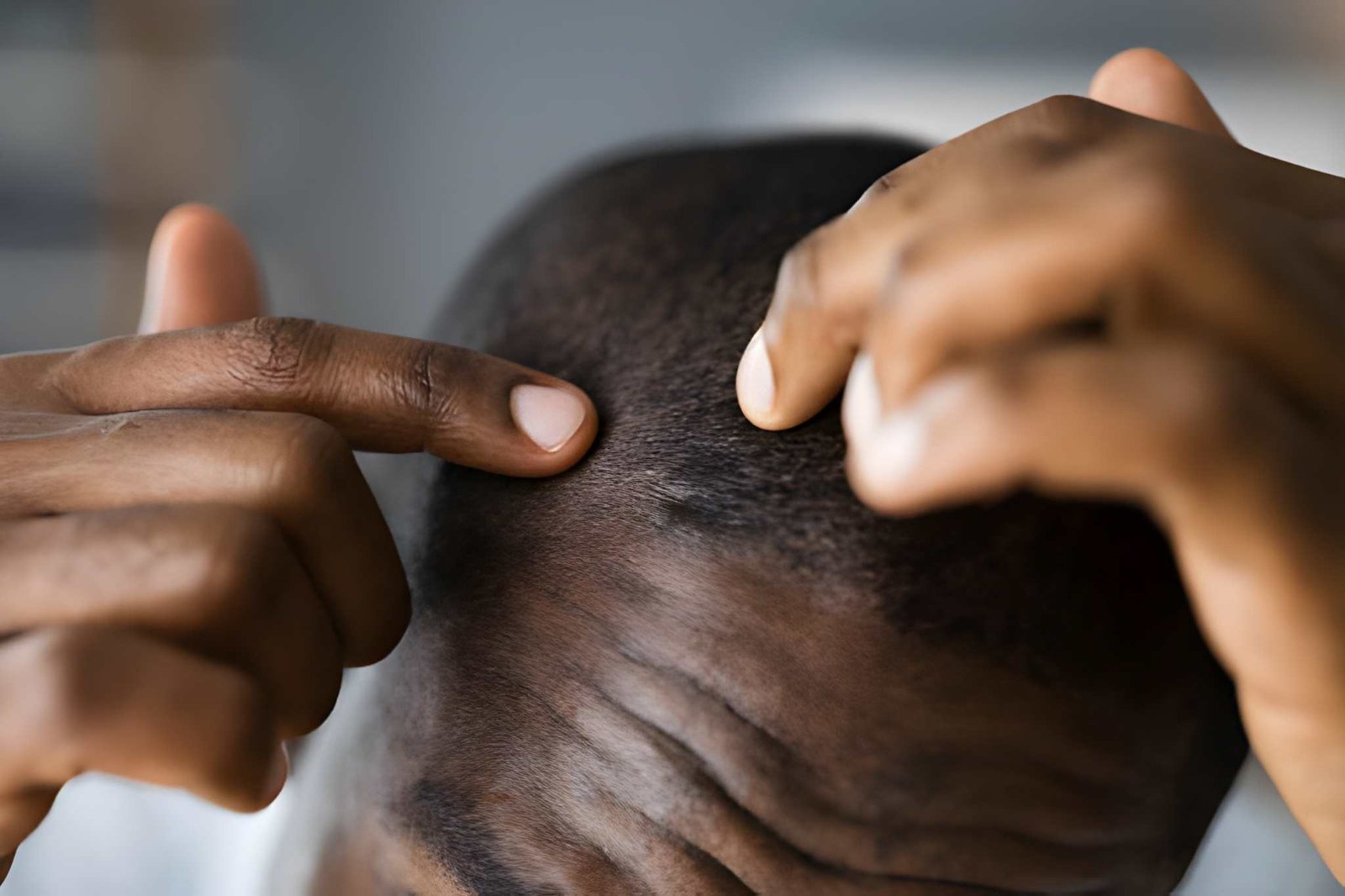 Traction Alopecia