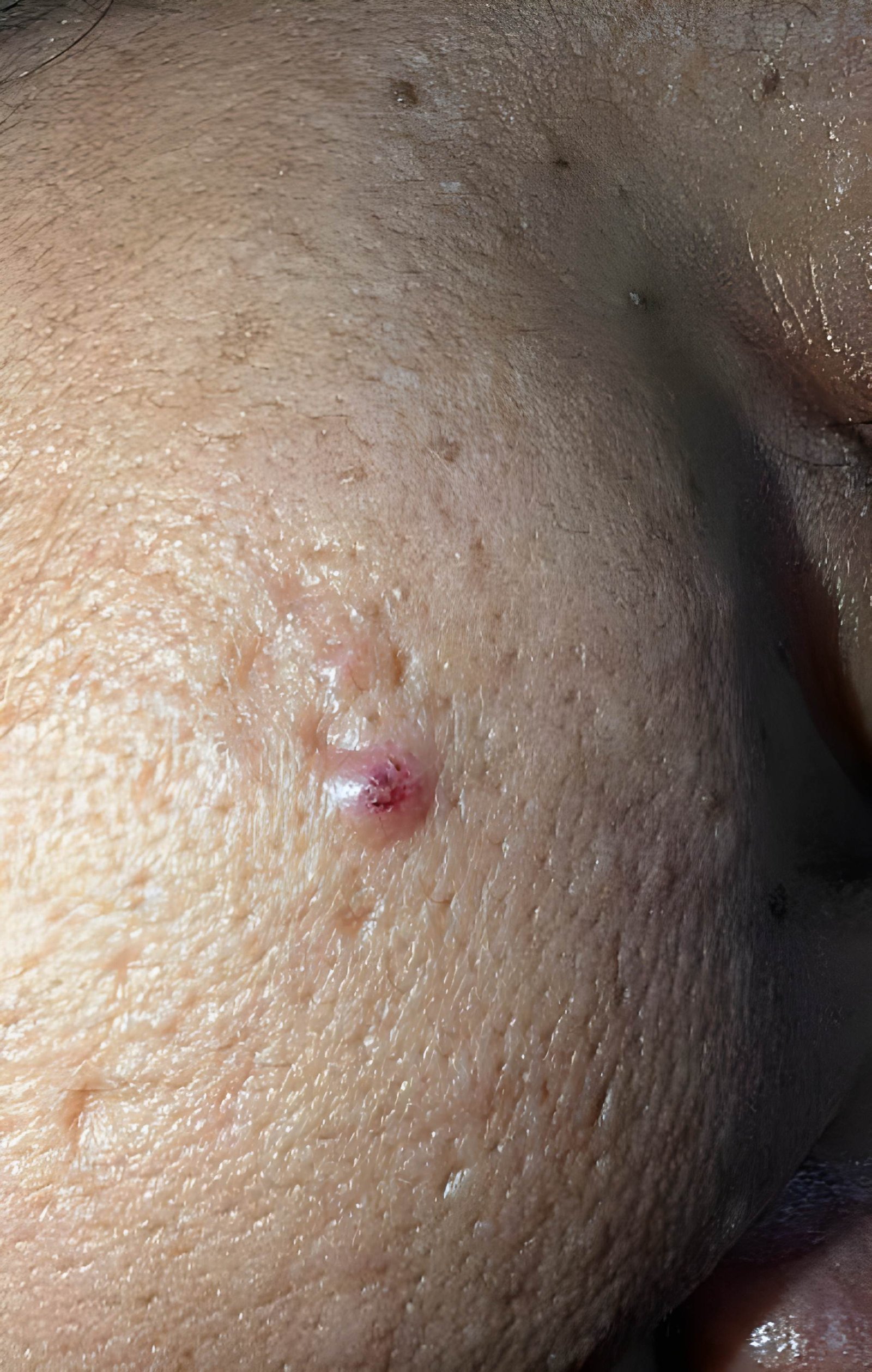 Under-breast skin tags treated at Skinfollix Clinic in Delhi