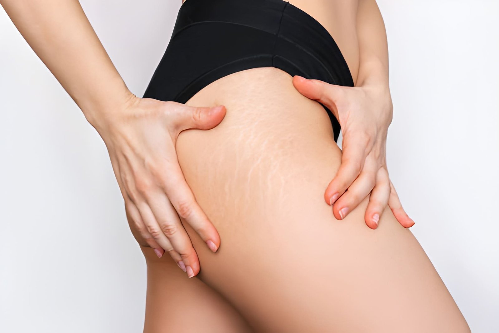 White stretch marks treatment in Delhi